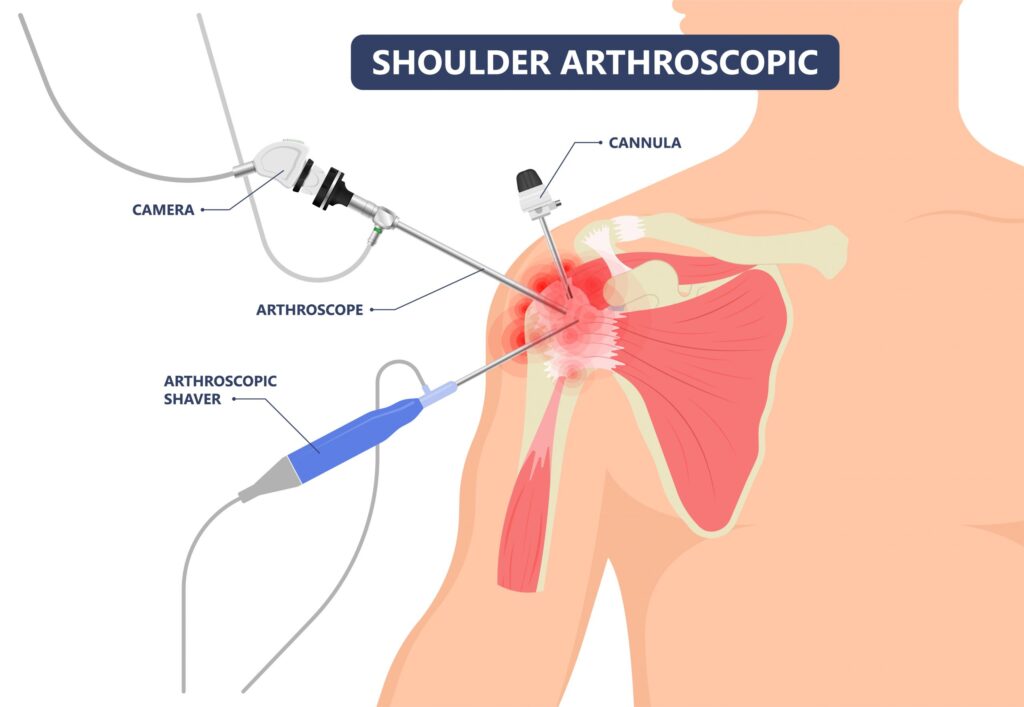 Arthroscopic-Shoulder-Surgery-1024x707