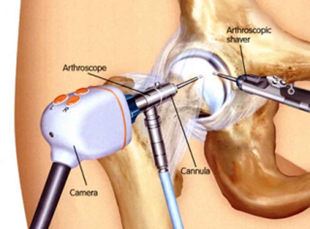 hip-arthroscopy